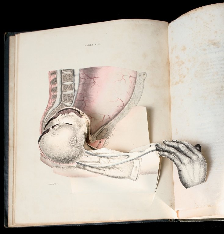 An opened book showing an illustration of a temporal and spatial dissection depicting a forceps delivery of a fetus. Obstetric tables, pt. 2, table 8.Courtesy of the National Library of